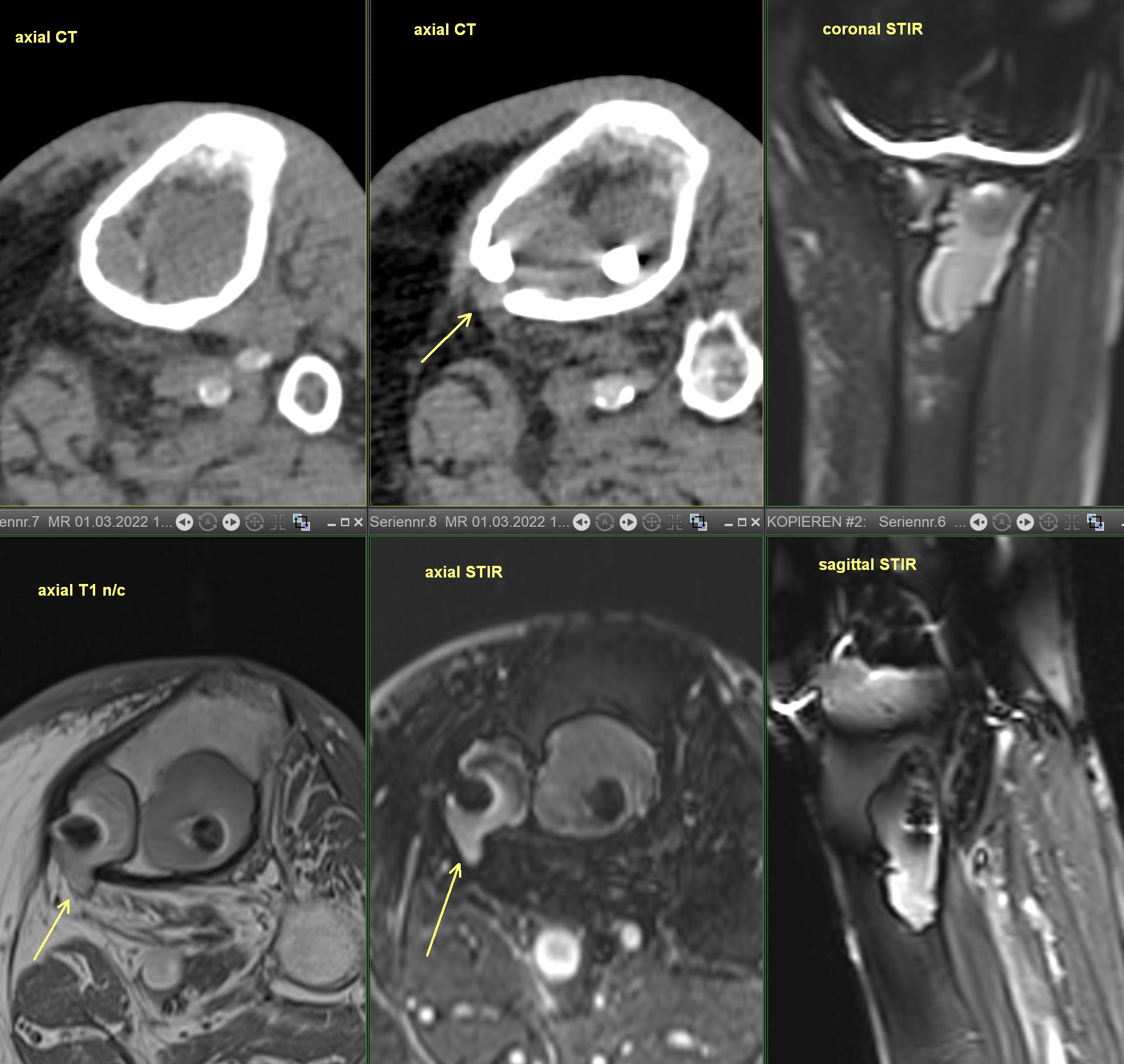 Figure 2 for case Presumed chronic material-related osteolysis